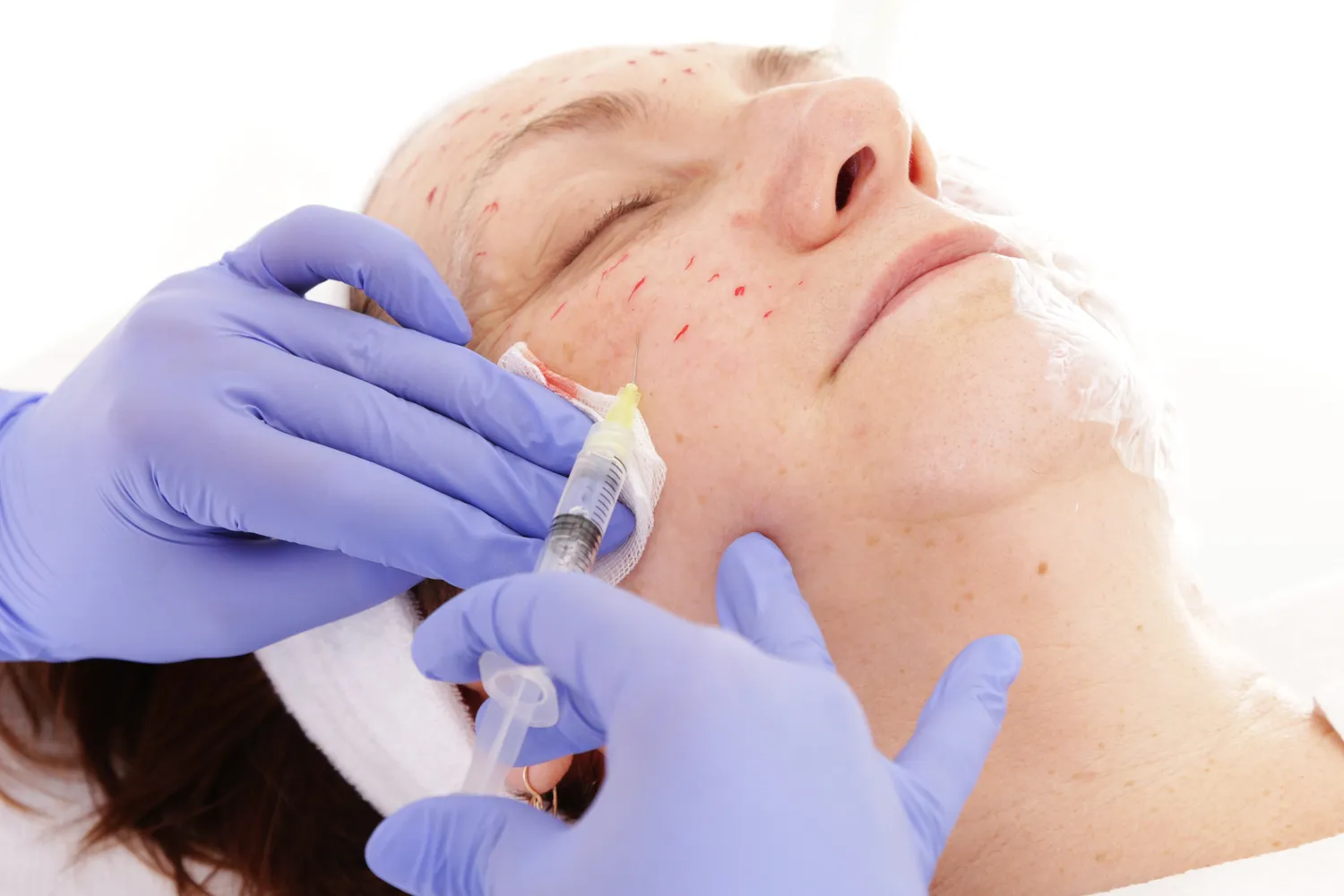 Co rozpuszcza kwas hialuronowy?